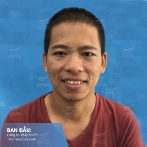 Hình ảnh niềng răng mắc cài – Nha khoa Smile one – Ca 14