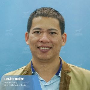 Hình ảnh niềng răng mắc cài – Nha khoa Smile one – Ca 14