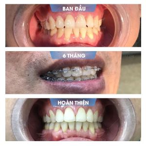 Hình ảnh niềng răng mắc cài – Nha khoa Smile one – Ca 14