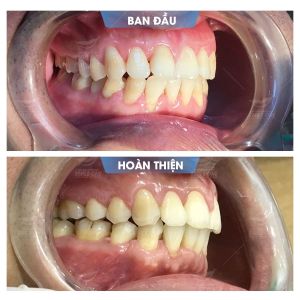 Hình ảnh niềng răng mắc cài – Nha khoa Smile one – Ca 14