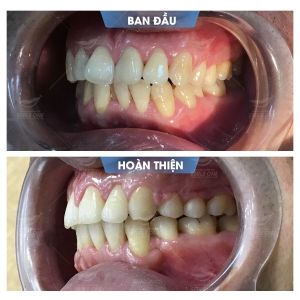 Hình ảnh niềng răng mắc cài – Nha khoa Smile one – Ca 14
