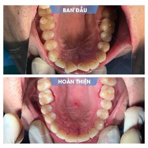 Hình ảnh niềng răng mắc cài – Nha khoa Smile one – Ca 14