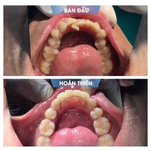 Hình ảnh niềng răng mắc cài – Nha khoa Smile one – Ca 14