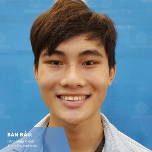 Hình ảnh niềng răng mắc cài của bạn Cường – Nha khoa Smile one – Ca 15