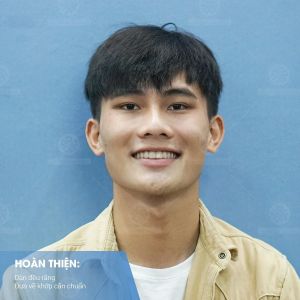 Hình ảnh niềng răng mắc cài của bạn Cường – Nha khoa Smile one – Ca 15