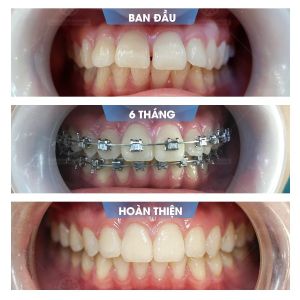 Hình ảnh niềng răng mắc cài của bạn Cường – Nha khoa Smile one – Ca 15