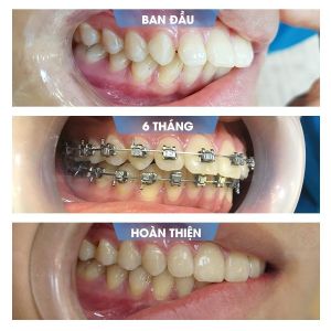 Hình ảnh niềng răng mắc cài của bạn Cường – Nha khoa Smile one – Ca 15