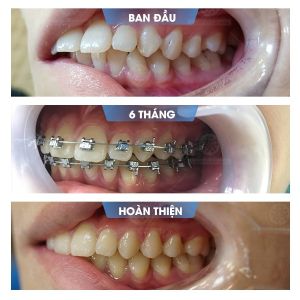 Hình ảnh niềng răng mắc cài của bạn Cường – Nha khoa Smile one – Ca 15