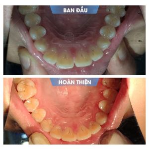 Hình ảnh niềng răng mắc cài của bạn Cường – Nha khoa Smile one – Ca 15