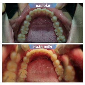 Hình ảnh niềng răng mắc cài của bạn Cường – Nha khoa Smile one – Ca 15