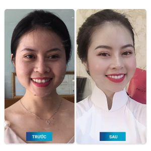 Hình ảnh dán sứ Veneer của ca sĩ Phùng Thủy – Nha khoa Smile one – Ca 16