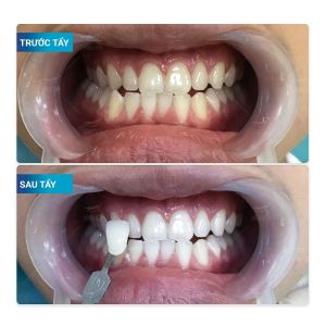 Hình ảnh tẩy trắng răng của KH Hoàng Tùng – Nha khoa Smile one – Ca 17
