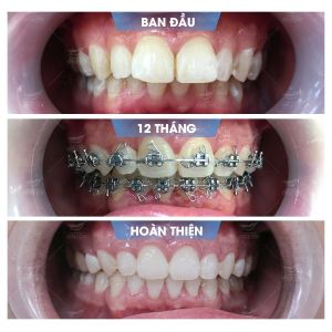 Hình ảnh niềng răng mắc cài của KH Nguyễn Quốc Trị - Nha khoa Smile one – Ca 18