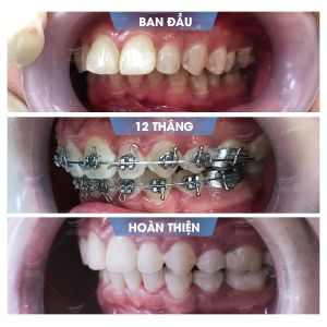 Hình ảnh niềng răng mắc cài của KH Nguyễn Quốc Trị - Nha khoa Smile one – Ca 18