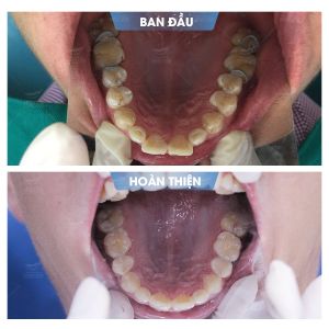 Hình ảnh niềng răng mắc cài của KH Nguyễn Quốc Trị - Nha khoa Smile one – Ca 18