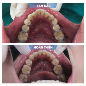 Hình ảnh niềng răng mắc cài của KH Nguyễn Quốc Trị - Nha khoa Smile one – Ca 18