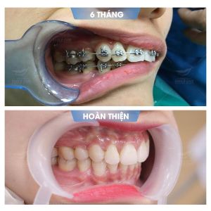 Hình ảnh niềng răng mắc cài của KH Trần Thị Ngọc Hà – Nha khoa Smile one – Ca 19