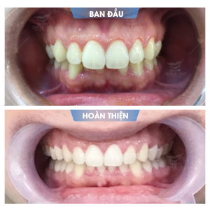 Hình ảnh Niềng răng invisalign – Nha khoa Smile one – Ca 2