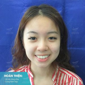 Hình ảnh niềng răng mắc cài của Trần Khánh Chi – Nha khoa Smile one – Ca 3