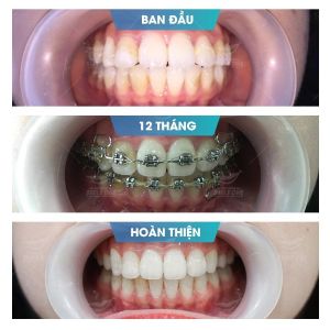 Hình ảnh niềng răng mắc cài của Trần Khánh Chi – Nha khoa Smile one – Ca 3