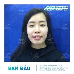 Hình ảnh niềng răng mắc cài của bạn Giang – Nha khoa Smile one – Ca 4