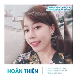 Hình ảnh niềng răng mắc cài của bạn Giang – Nha khoa Smile one – Ca 4