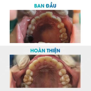 Hình ảnh niềng răng mắc cài của bạn Giang – Nha khoa Smile one – Ca 4
