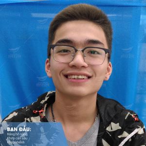 Hình ảnh niềng răng mắc cài của KH Anh Tú – Nha khoa Smile one – Ca 6