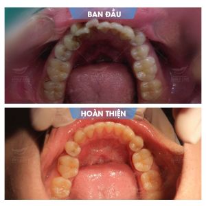 Hình ảnh niềng răng mắc cài của KH Anh Tú – Nha khoa Smile one – Ca 6