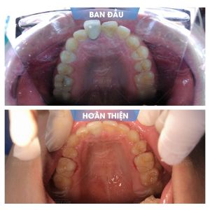 Hình ảnh niềng răng mắc cài của KH Anh Tú – Nha khoa Smile one – Ca 6