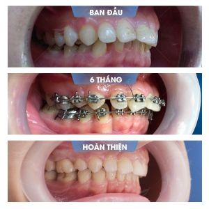 Hình ảnh niềng răng mắc cài của KH Anh Tú – Nha khoa Smile one – Ca 6