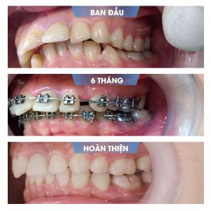 Hình ảnh niềng răng mắc cài của KH Anh Tú – Nha khoa Smile one – Ca 6