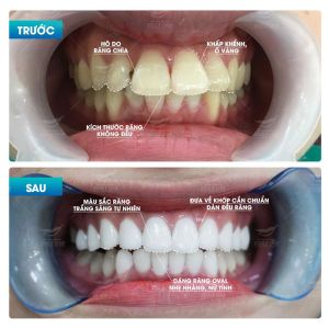 Hình ảnh bọc răng sứ của KH Đào Nga – Nha khoa Smile one – Ca 7