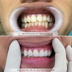 Hình ảnh dán sứ Veneer của KH Triệu Hải – Nha khoa Smile one – Ca 8