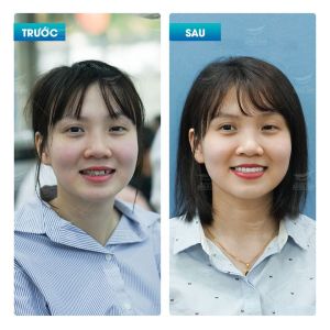 Hình ảnh dán sứ Veneer của KH Thu Trang – Nha khoa Smile one – Ca 9