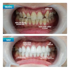 Hình ảnh dán sứ Veneer của KH Thu Trang – Nha khoa Smile one – Ca 9