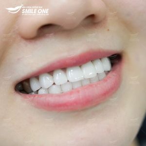 Hình ảnh dán sứ Veneer của KH Thu Trang – Nha khoa Smile one – Ca 9