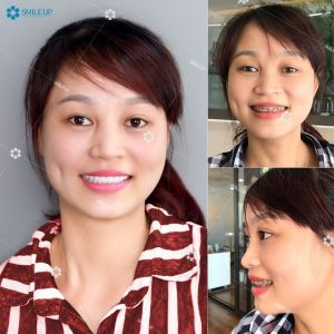 Hình ảnh bọc răng sứ - Viện NKQT Smile up  - Ca 13