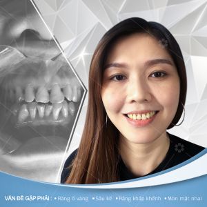 Hình ảnh bọc răng sứ của KH Thắm Bùi – Viện NKQT Smile up – Ca 15