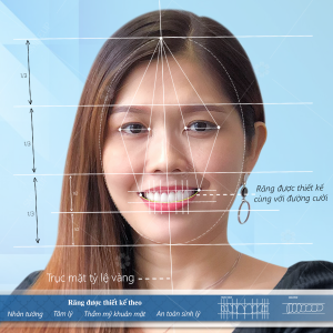 Hình ảnh bọc răng sứ của KH Thắm Bùi – Viện NKQT Smile up – Ca 15