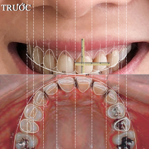 Hình ảnh bọc răng sứ - Viện NKQT Smile up  - Ca 17