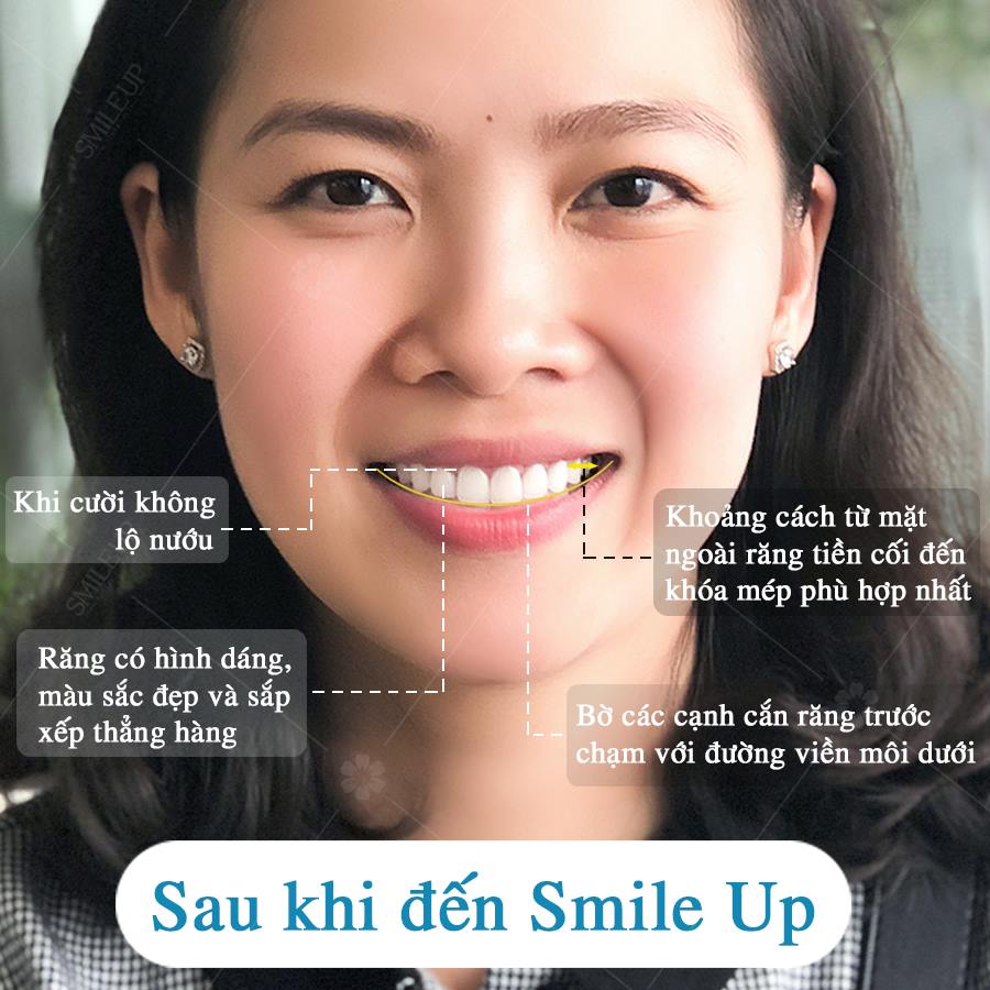 Hình Ảnh Bọc Răng Sứ: Hình Ảnh Bọc Răng Sứ - Viện Nkqt Smile Up - Ca 17 -  Bs Nha Khoa Smile Up