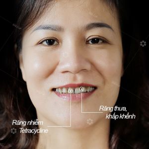 Hình ảnh bọc răng sứ của KH Nguyễn Thị Thương – Viện NKQT Smile up  - Ca 20