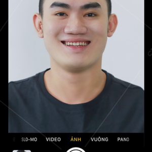 Hình ảnh bọc răng sứ - Viện NKQT Smile up  - Ca 21