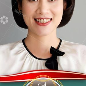 Hình ảnh bọc răng sứ - Viện NKQT Smile up  - Ca 7