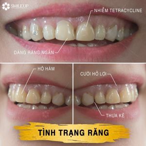 Hình ảnh bọc răng sứ của KH Hồ Thị Phương Thanh – Viện NKQT Smile up  - Ca 9