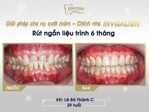 Hình ảnh niềng răng invisalign của KH Lê Bá Thành C – Nha khoa Sentosa – Ca 10