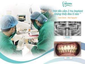 Hình ảnh trồng răng implant của KH Phạm Văn C – Nha khoa Sentosa – Ca 11