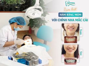 Hình ảnh niềng răng mắc cài của bạn Thúy H – Nha khoa Sentosa – Ca 12