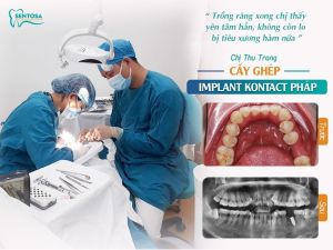 Hình ảnh trồng răng implant của KH Thu Trang – Nha khoa Sentosa – Ca 13